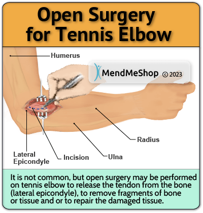 Tennis Elbow open elbow surgery - 90% can heal through conservative treatment methods.