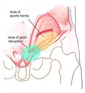 Groin Injury locations