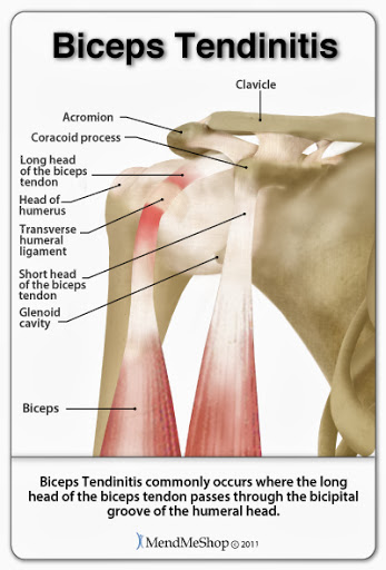 Bicep tendonitis, is caused by overusing the soft tissue in your shoulder and arm