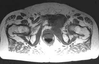 Hip/Groin MRI
