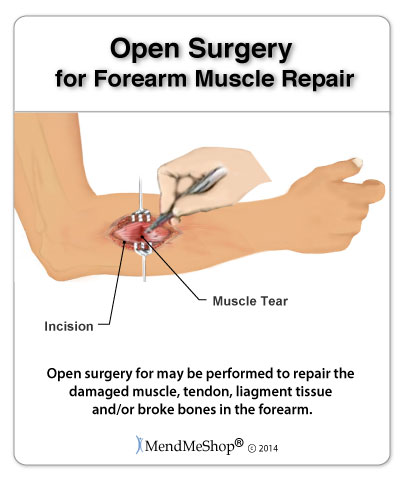 open muscle surgery repair for forearm pain