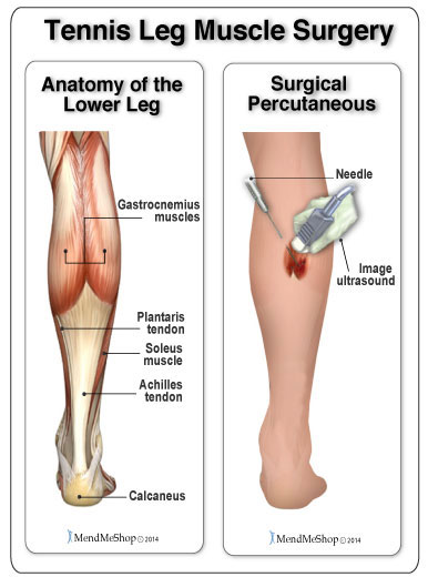 percutaneous surgery repair for tennis leg