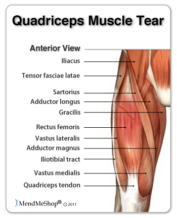 quadriceps strains result from jumping