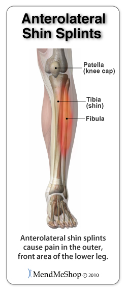 Anterolateral Shin Splint pain areas