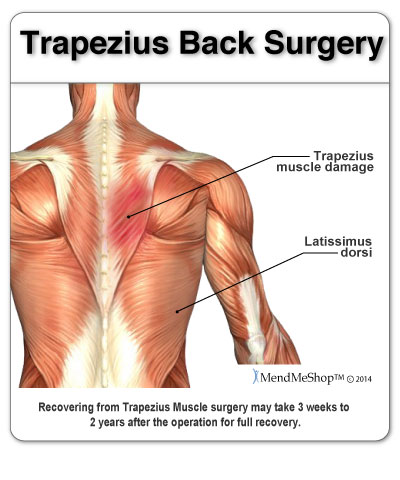 how long does it take for trapezius surgery to heal.