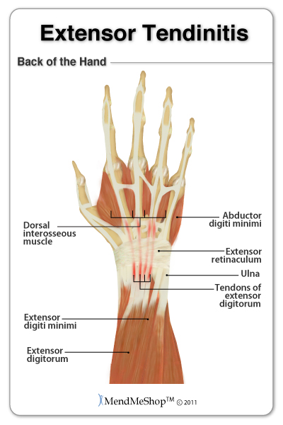 Extensor Tendonitis in the hand